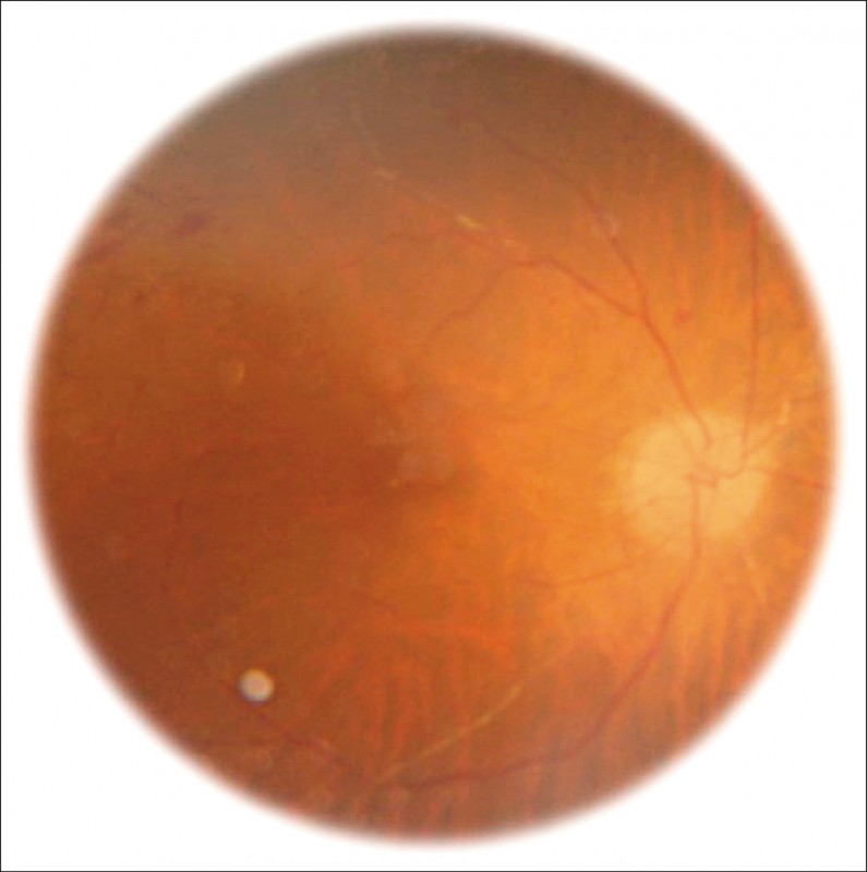 圖1:巨細胞病毒之全葡萄膜炎。(照片提供/林純如)